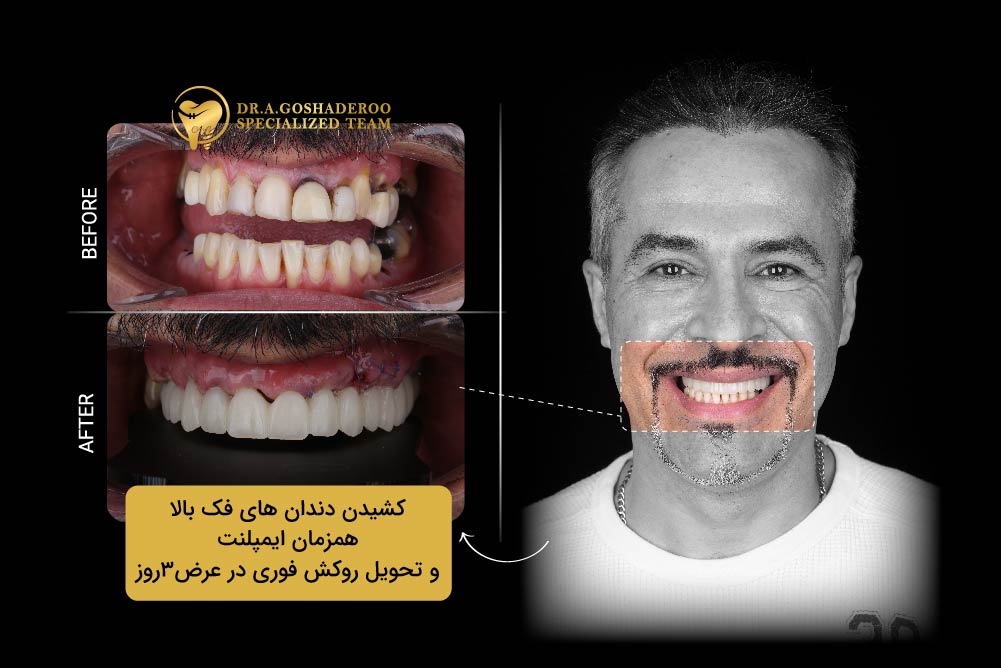 خدمات تخصصی ایمپلنت در مرکز دکتر گشاده‌رو